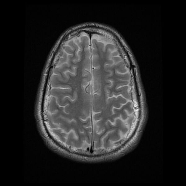 File:Chiasmatic-hypothalamic juvenile pilocytic astrocytoma (Radiopaedia 78533-91235 Axial T2 22).jpg