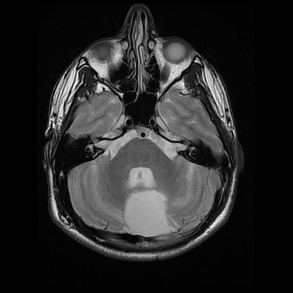 File:Chiasmatic-hypothalamic juvenile pilocytic astrocytoma (Radiopaedia 78533-91235 Axial T2 9).jpg