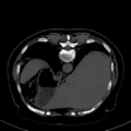 Cholecystitis - CT IVC obstructive choledocholitiasis (Radiopaedia 43966-47479 Axial Biliscopin 23).png