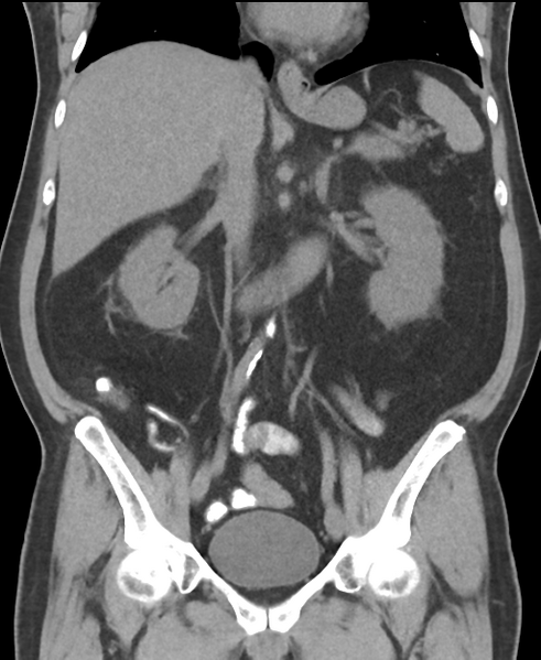 File:Cholecystitis with focal perforation and hepatic abscess (Radiopaedia 37189-38945 Coronal non-contrast 31).png