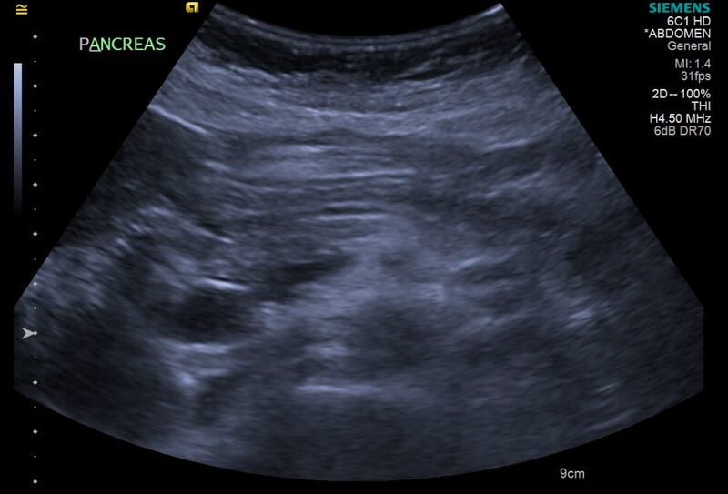 File:Cholelithiasis with biliary dilatation (Radiopaedia 49442-54588 A 11).jpg