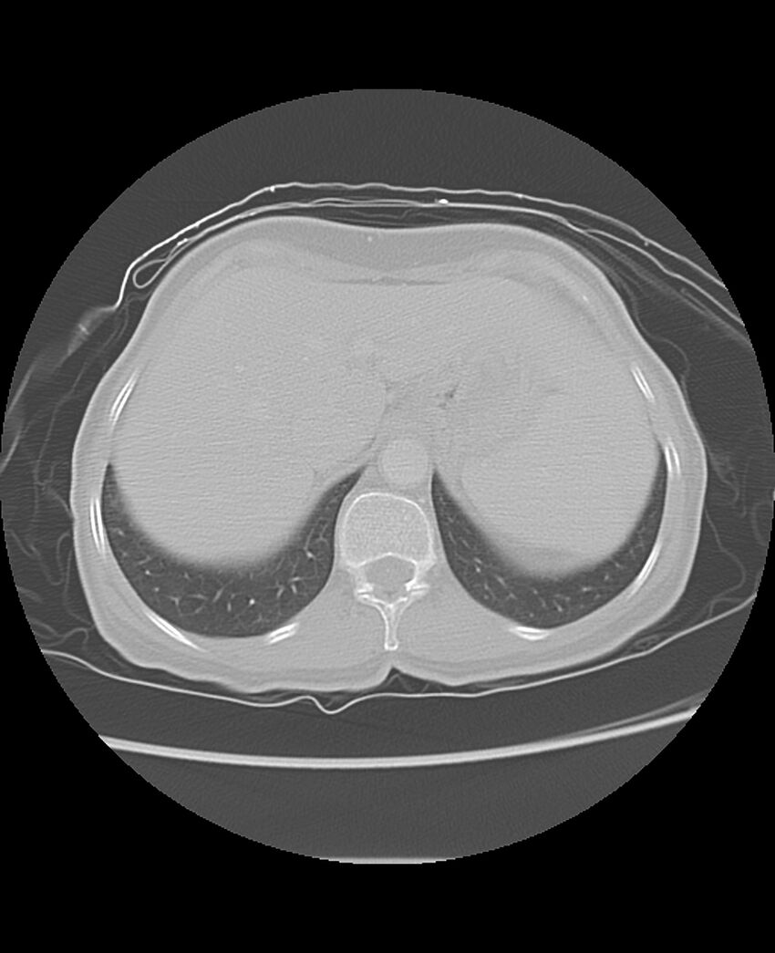 Chondrosarcoma (Radiopaedia 79427-92532 Axial lung window 51).jpg
