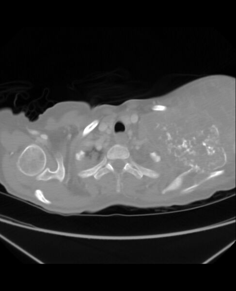 File:Chondrosarcoma (Radiopaedia 79427-92535 Axial lung window 4).jpg