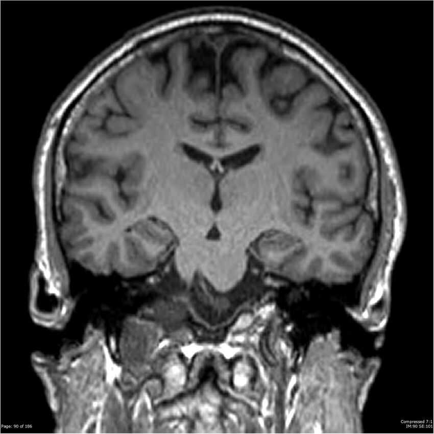 Chondrosarcoma of skull base- grade II (Radiopaedia 40948-43654 Coronal T1 11).jpg