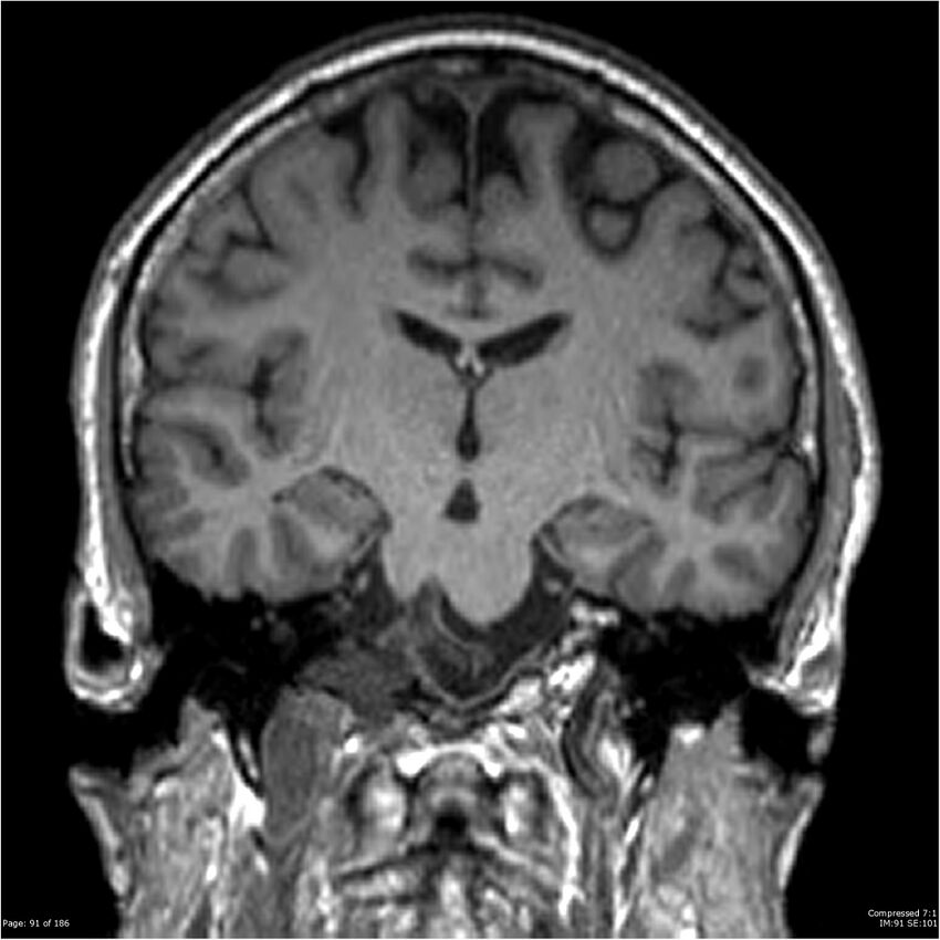 Chondrosarcoma of skull base- grade II (Radiopaedia 40948-43654 Coronal T1 12).jpg