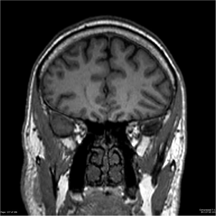 Chondrosarcoma of skull base- grade II (Radiopaedia 40948-43654 Coronal T1 58).jpg