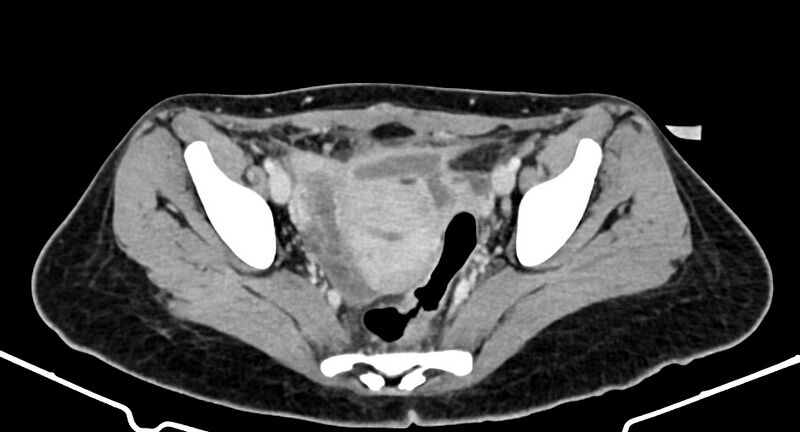 File:Choriocarcinoma liver metastases (Radiopaedia 74768-85766 A 177).jpg