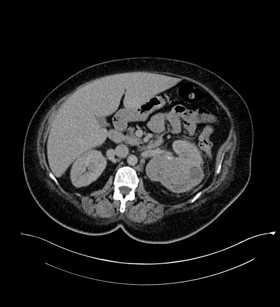 File:Chromophobe renal cell carcinoma (Radiopaedia 84239-99519 E 70).jpg