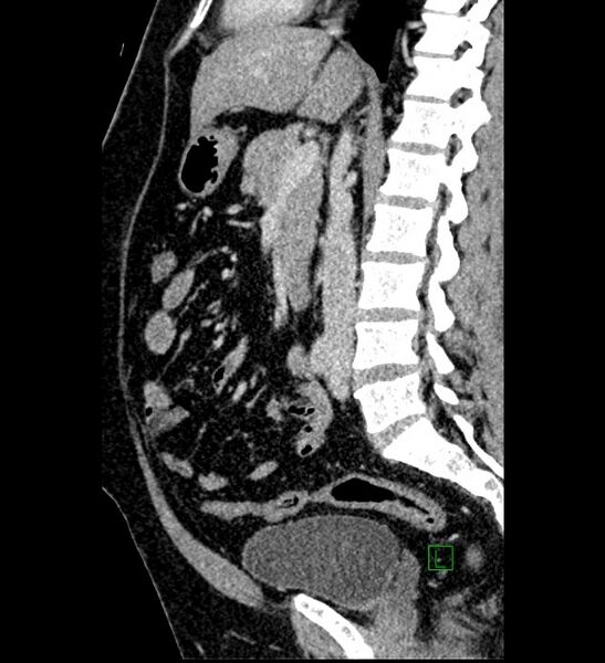File:Chromophobe renal cell carcinoma (Radiopaedia 84286-99573 I 96).jpg