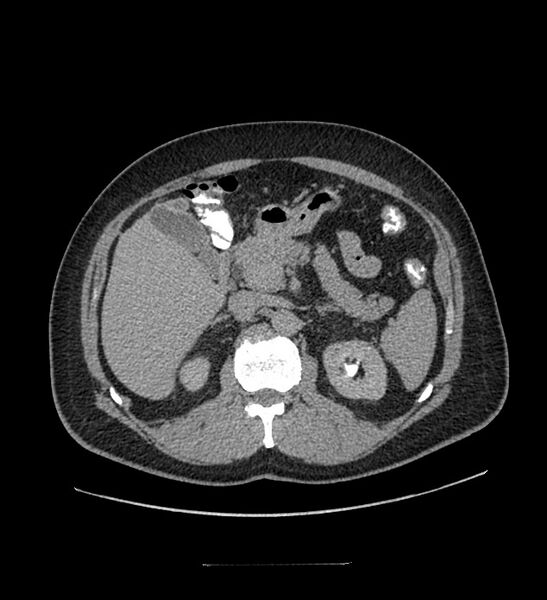 File:Chromophobe renal cell carcinoma (Radiopaedia 84337-99644 Axial C+ delayed 48).jpg