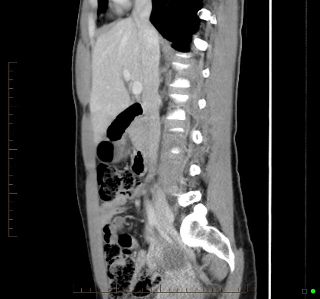 File:Chronic abscess due to "dropped" appendicoliths following appendectomy for perforated appendix (Radiopaedia 58805-66344 D 34).jpg