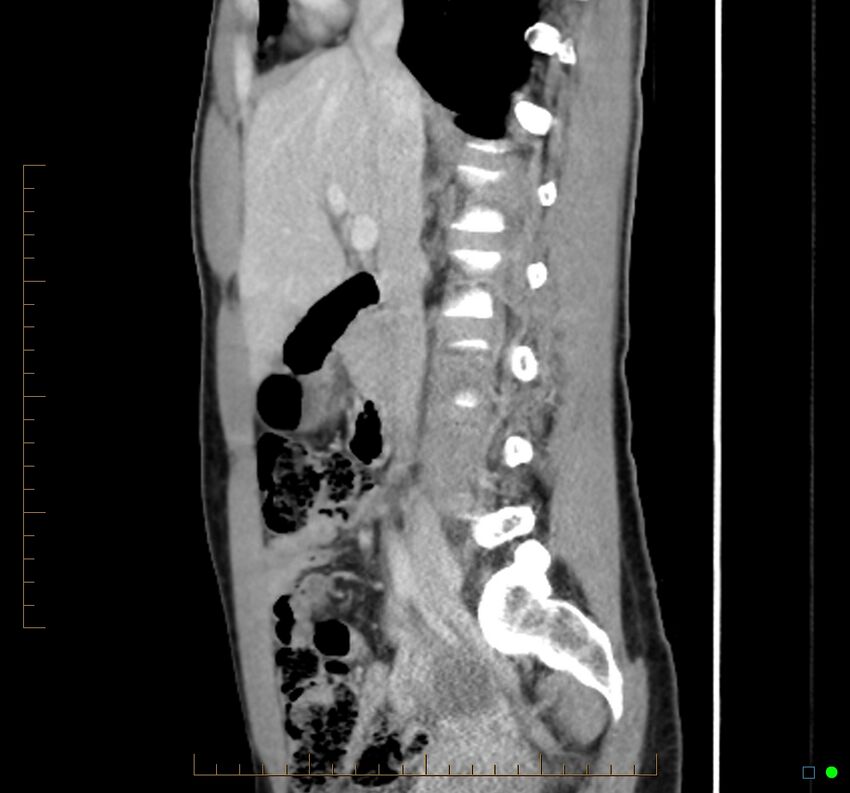 Chronic abscess due to "dropped" appendicoliths following appendectomy for perforated appendix (Radiopaedia 58805-66344 D 34).jpg
