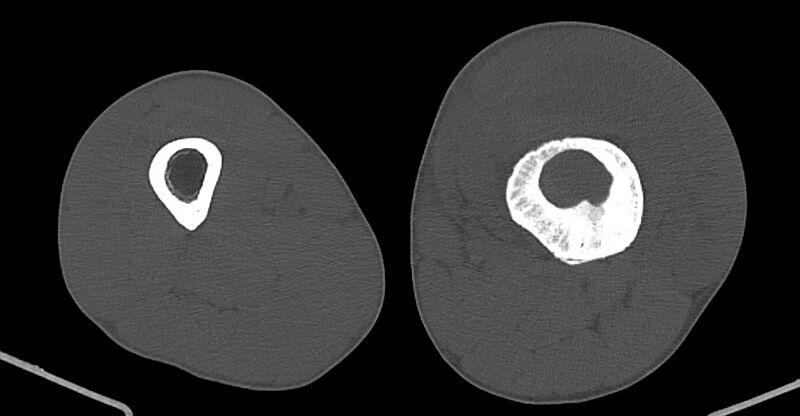 File:Chronic osteomyelitis (with sequestrum) (Radiopaedia 74813-85822 Axial non-contrast 116).jpg