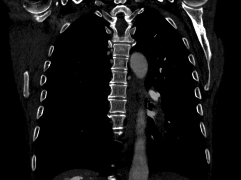 File:Chronic pulmonary embolism (Radiopaedia 91241-108843 A 75).jpg