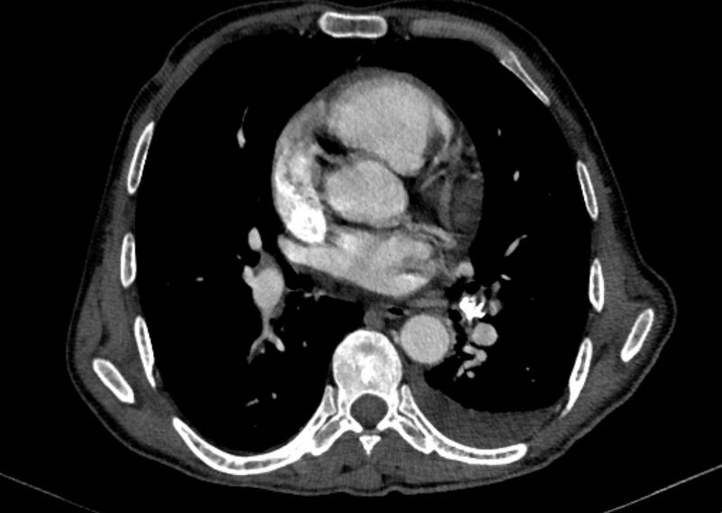 File:Chronic pulmonary embolism with bubbly consolidation (Radiopaedia 91248-108850 C+ arterial phase 83).jpg