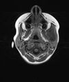 Chronic reactive multifocal osteomyelitis (CRMO) - mandible (Radiopaedia 56405-63069 Axial T1 16).jpg