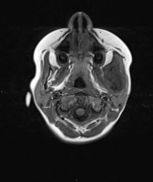 File:Chronic reactive multifocal osteomyelitis (CRMO) - mandible (Radiopaedia 56405-63069 Axial T1 16).jpg
