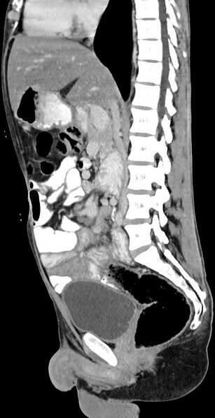 File:Chronic small bowel volvulus (Radiopaedia 75224-86322 C 79).jpg
