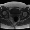 Class II Mullerian duct anomaly- unicornuate uterus with rudimentary horn and non-communicating cavity (Radiopaedia 39441-41755 Axial T1 21).jpg