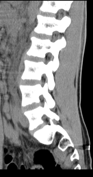 File:Clear cell meningoma - lumbar spine (Radiopaedia 60116-67691 A 17).png