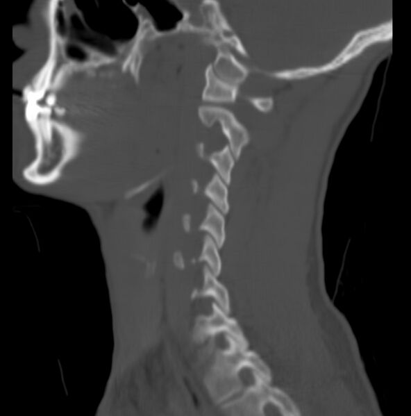 File:Cleft of the posterior arch of C1 mimicking fracture (Radiopaedia 40201-42721 Sagittal bone window 3).jpg