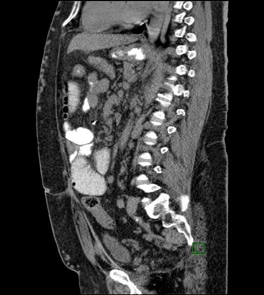 File:Closed-loop small bowel obstruction-internal hernia (Radiopaedia 78439-91096 C 68).jpg