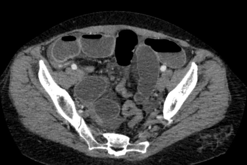 File:Closed loop small bowel obstruction (Radiopaedia 71211-81508 A 131).jpg