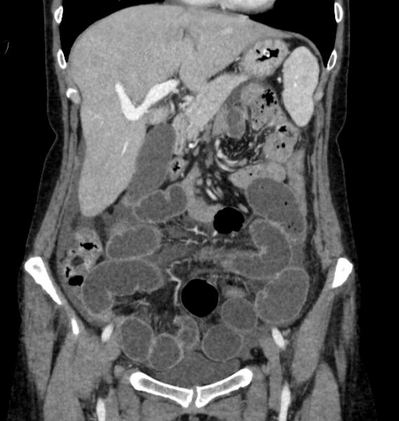 File:Closed loop small bowel obstruction (Radiopaedia 71211-81508 B 34).jpg