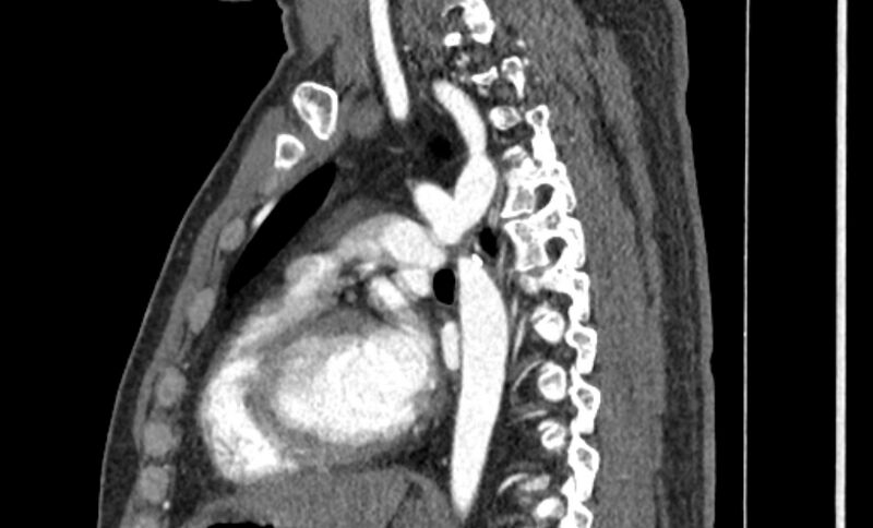 File:Coarctation of the aorta (Radiopaedia 53363-59343 B 38).jpg
