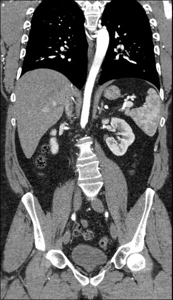 File:Coarctation of the aorta (Radiopaedia 74632-88521 B 140).jpg