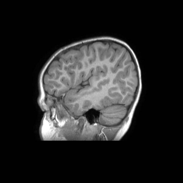 File:Cochlear nerve aplasia - unilateral (Radiopaedia 87910-104413 Sagittal T1 38).jpg