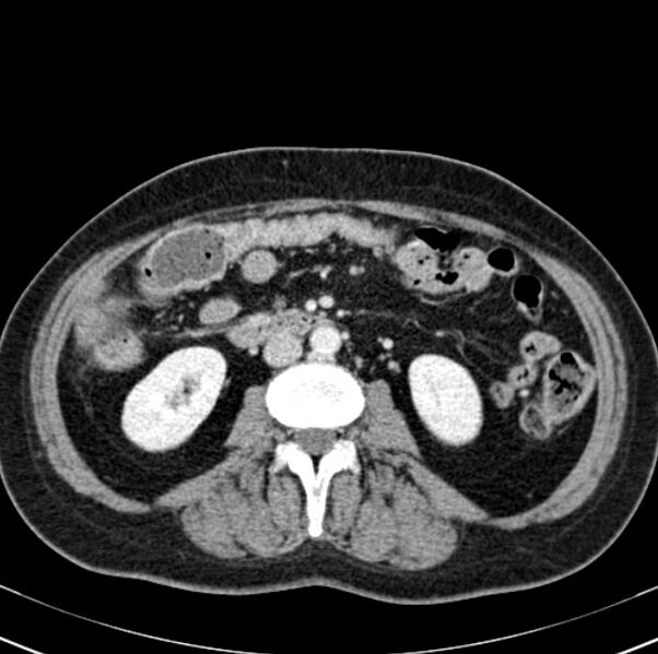 File:Colon carcinoma with hepatic metastases (Radiopaedia 29477-29961 A 56).jpg