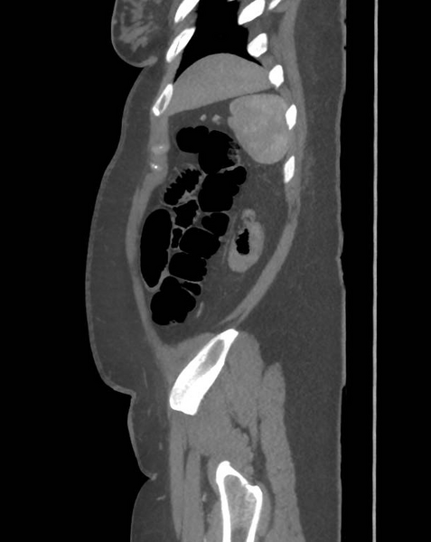 File:Colonic pseudo-obstruction (Radiopaedia 79752-92980 C 64).png