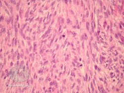 pathology-Fibrosarcoma