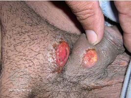 Granuloma inguinale (DermNet NZ bacterial-graning2).jpg