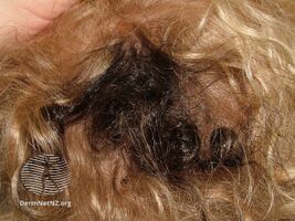 Hypertrichosis (DermNet NZ hair-nails-sweat-scalp-naevus).jpg