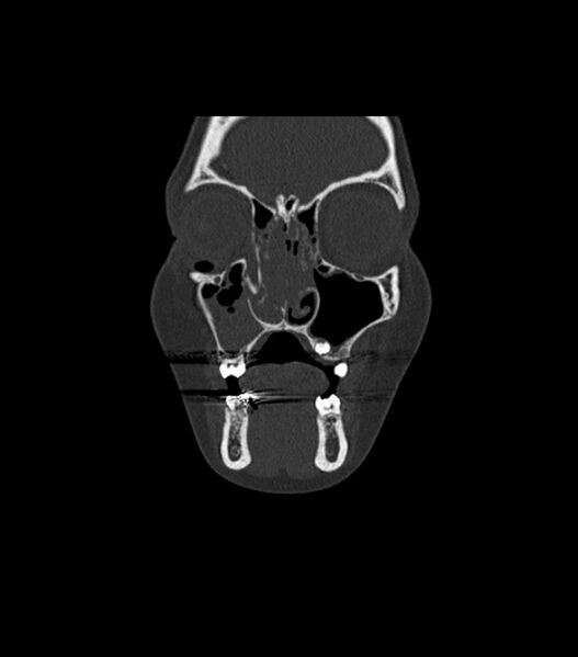 File:Nasoorbitoethmoid fracture (Radiopaedia 90044-107205 Coronal bone window 38).jpg