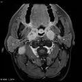 Nasopharyngeal carcinoma (Radiopaedia 4546-6667 Axial T1 C+ fat sat 14).jpg