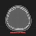 Nasopharyngeal carcinoma recurrence - skull base destruction (Radiopaedia 29107-29490 Axial bone window 24).jpg