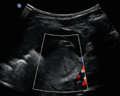 Neonatal neuroblastoma (Radiopaedia 56651-63437 A 3).png