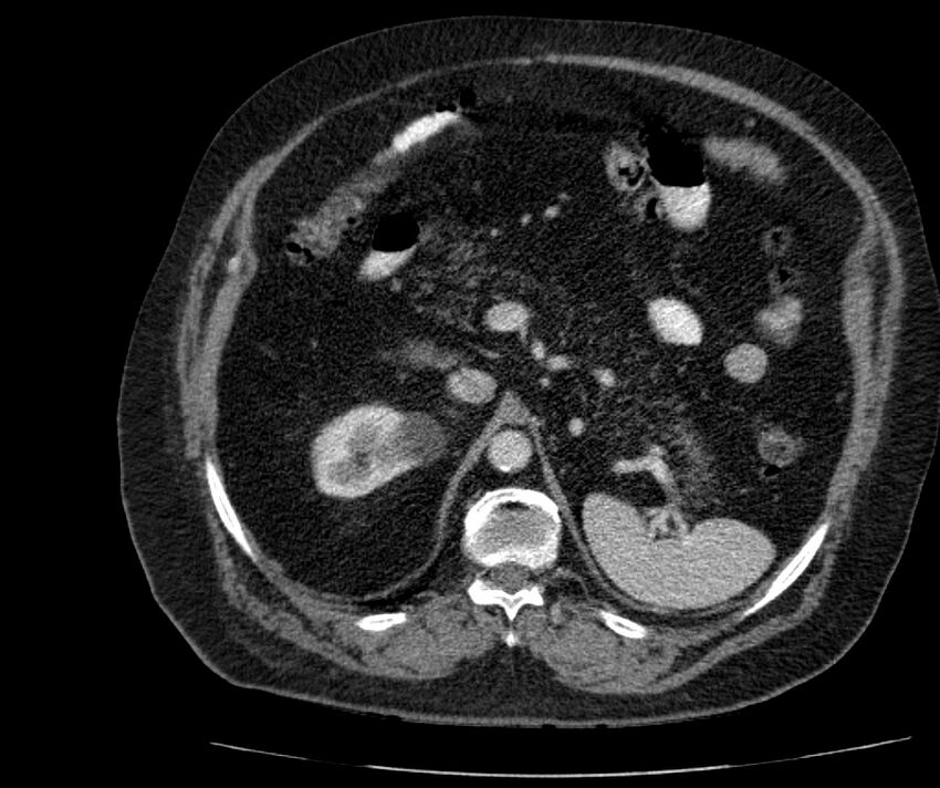 Nephroptosis with inguinal hernia containing perirenal fat (Radiopaedia 56632-63391 C 112).jpg