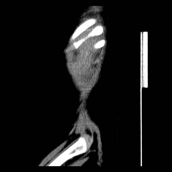 File:Neuroblastoma with skull metastases (Radiopaedia 30326-30960 B 1).jpg