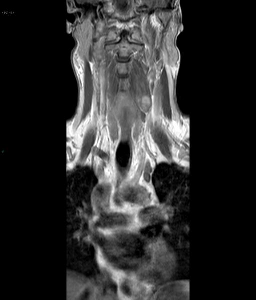 File:Neurofibromatosis type 1 (Radiopaedia 36933-38560 Coronal T1 6).jpg
