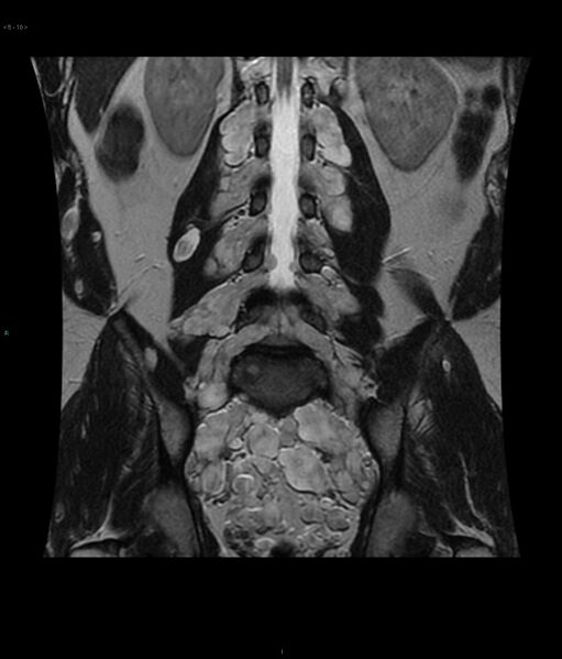File:Neurofibromatosis type 1 (Radiopaedia 36933-38560 Coronal T2 10).jpg