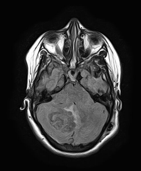 File:Neurofibromatosis type 2 (Radiopaedia 66211-75401 Axial FLAIR 11).jpg