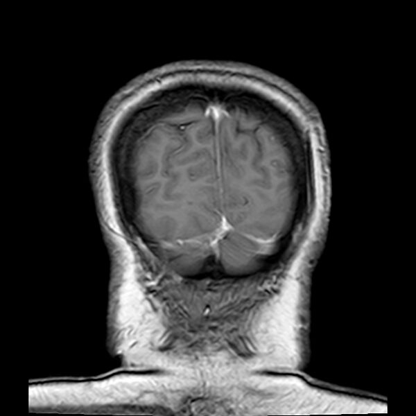 File:Neurofibromatosis type 2 (Radiopaedia 67470-76871 Coronal T1 C+ 22).jpg