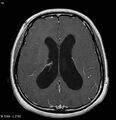 Neurofibromatosis type 2 - cranial and spinal involvement (Radiopaedia 5351-7111 Axial T1 C+ 12).jpg