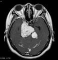 Neurofibromatosis type 2 - cranial and spinal involvement (Radiopaedia 5351-7111 Axial T1 C+ 7).jpg