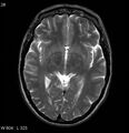 Neurosarcoidosis (Radiopaedia 10930-17204 Axial T2 9).jpg