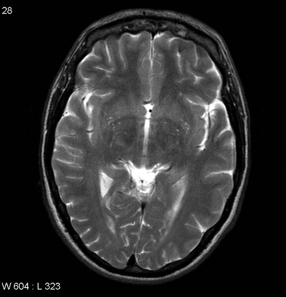 File:Neurosarcoidosis (Radiopaedia 10930-17204 Axial T2 9).jpg